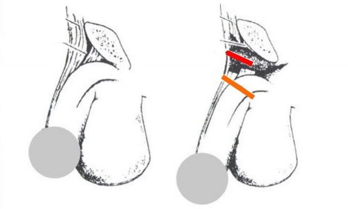 Ligamentotomía para agrandamento do pene